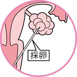 採卵
