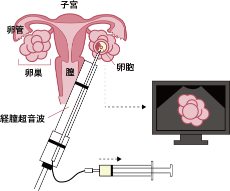 採卵の方法の画像
